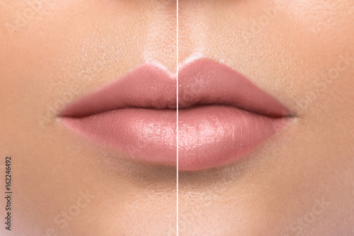 Photo Comparison of female lips after augmentation