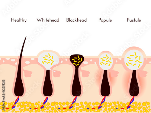 Skin problems. Types of acne pimples. Facial treatments and problem vector illustration. Whiteheads and Blackheads, Papules and Pustules