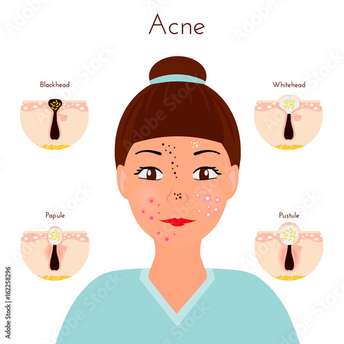 Skin problems. Girl closse up face with different types of acne pimples. Facial treatments and problems vector illustration. Whiteheads and Blackheads, Papules and Pustules, stages of development