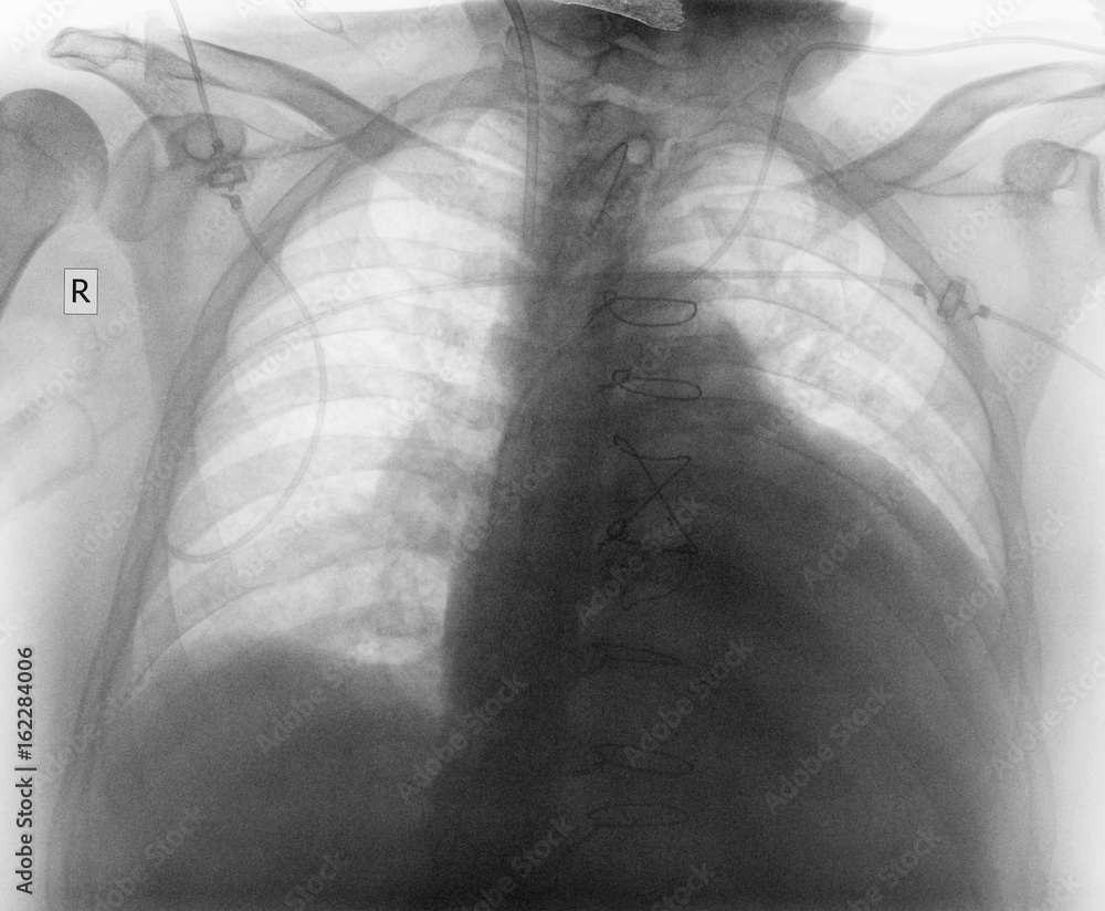 Can You Live Long After Heart Surgery Can You Live Long After Heart Surgery