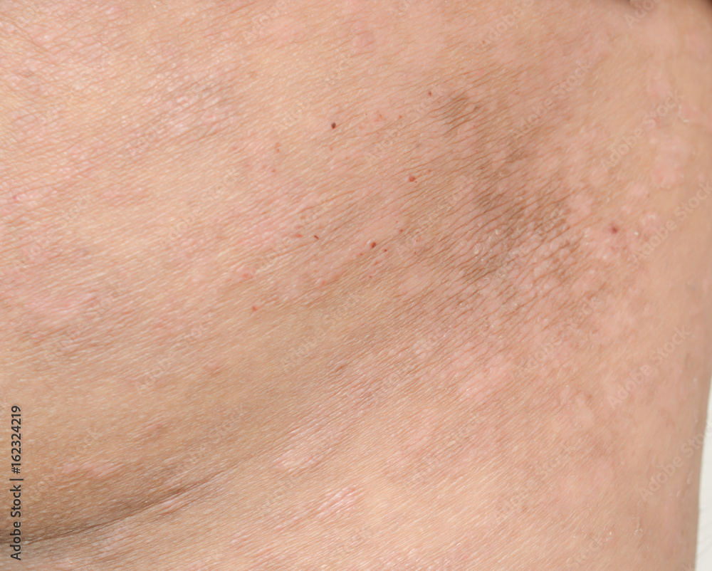 Psoriasis on the skin