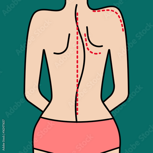 Scoliosis