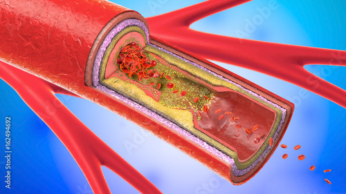 3d illustration of a precipitated and narrowing blood vessels or arteriosclerosis photo