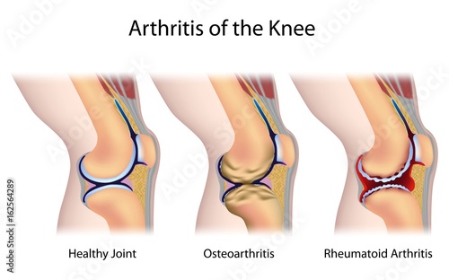 Common types of arthritis of the knee joint photo