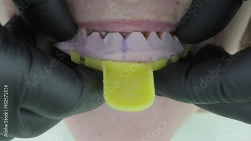 Patient's temporary installation of slips before veneers in dental clinic. Cosmetic dentistry is the veneers