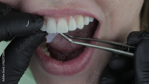 Patient's temporary installation veneers in dental clinic. Veneers after fixation. Natural color.