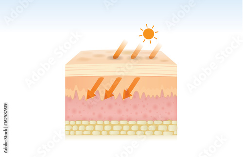 Skin damaged by the absorption of energy from UV rays. Illustration about medical and health care.