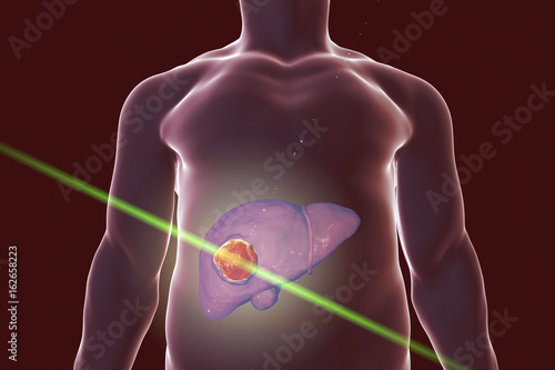 фотографія Liver cancer treatment with laser