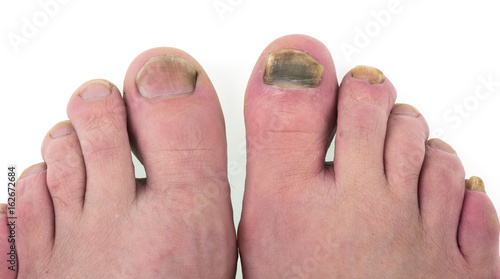 Canvas Print Sick nail on the leg, fungus on the big toe