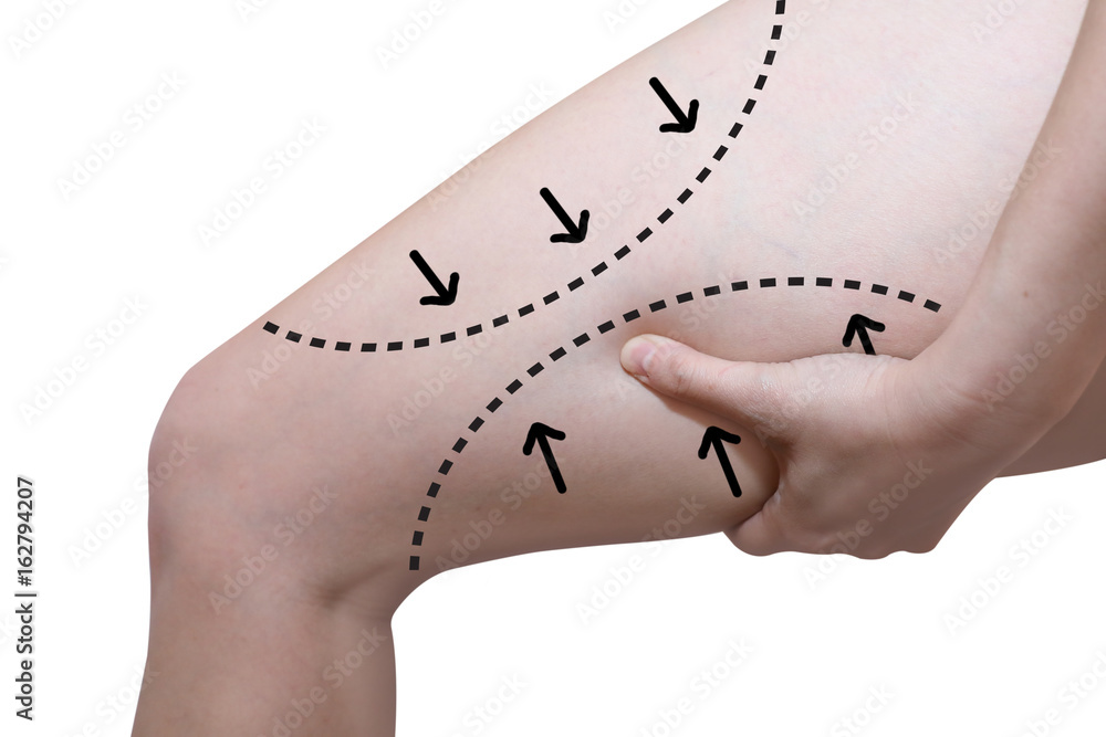 woman grabbing  her thigh  with the arrow line in  liposuction cellulite removal concept - obrazy, fototapety, plakaty 