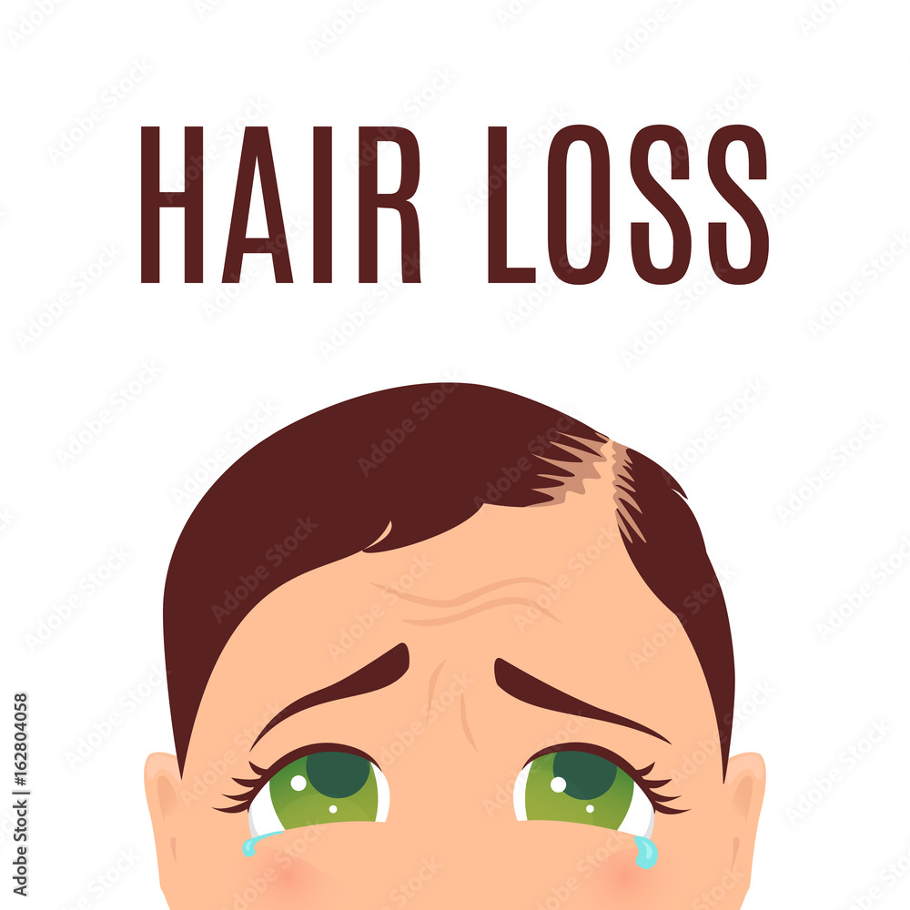 Woman suffering from hair loss. Alopecia treatment and transplantation concept. Can be used by clinics and diagnostic centers. Isolated vector illustration.
Woman suffering from hair loss. Alopecia treatment and transplantation concept. Can be used by clinics and diagnostic centers. Isolated vector illustration.