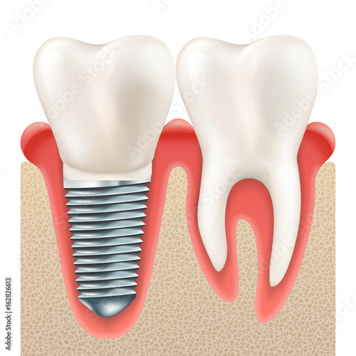Dental implant set. EPS 10