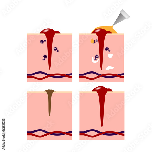 infographic of how the wound heal by medicine , platelet and white blood cell vector
