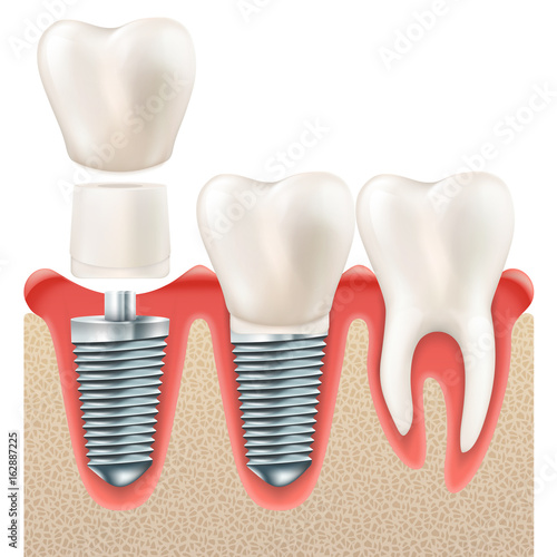 Dental implant set. EPS 10