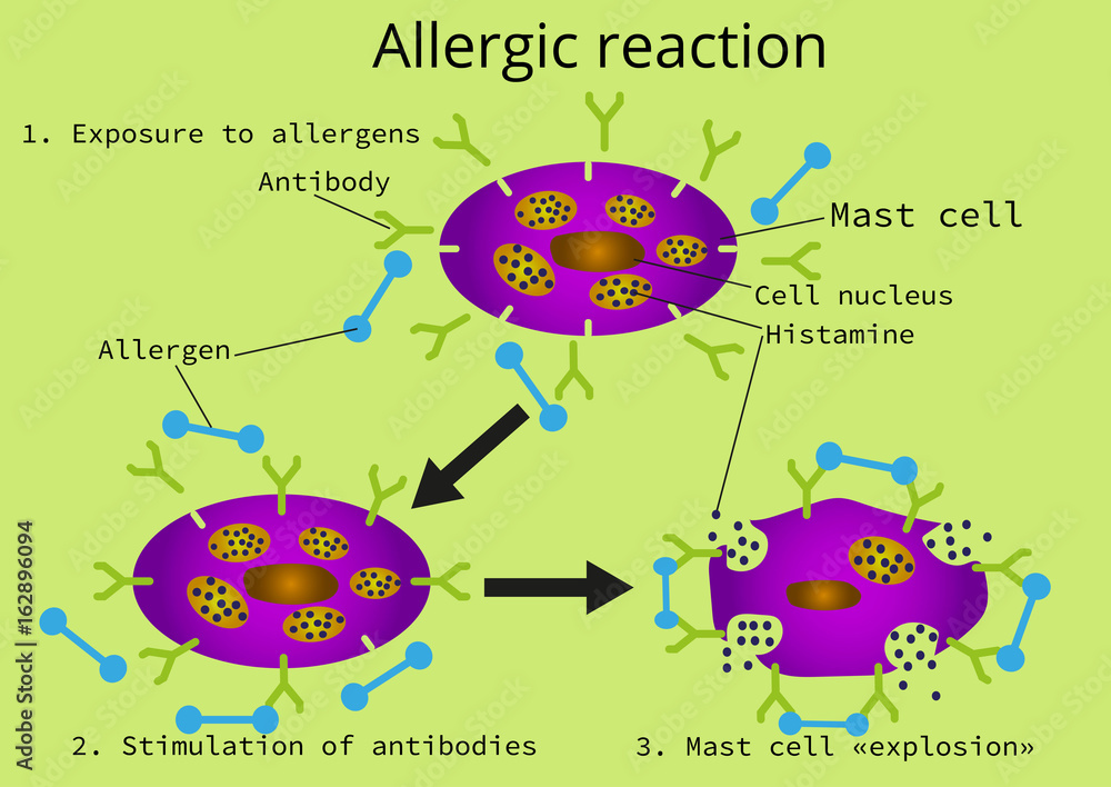 Three phases of an allergic reaction vector de Stock Adobe Stock