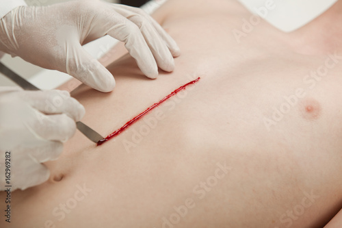 Doctor making an incision in the chest of a boy photo