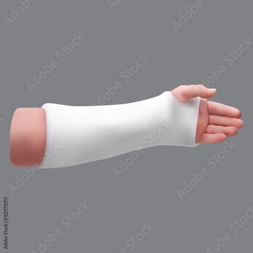 Gypsized broken arm. Isolated realistic object. Vector