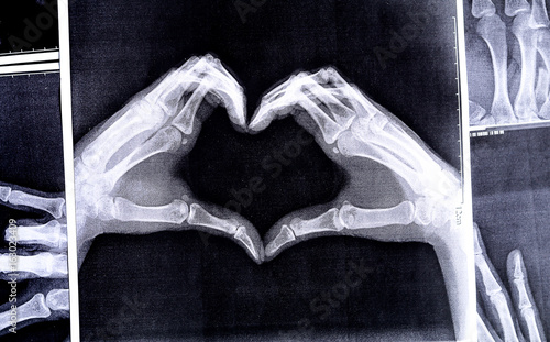 X-ray image of hands making heart symbols. photo