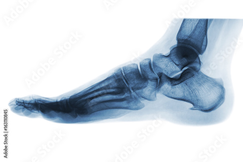 X-ray normal human foot . Lateral view . Invert color style . © stockdevil