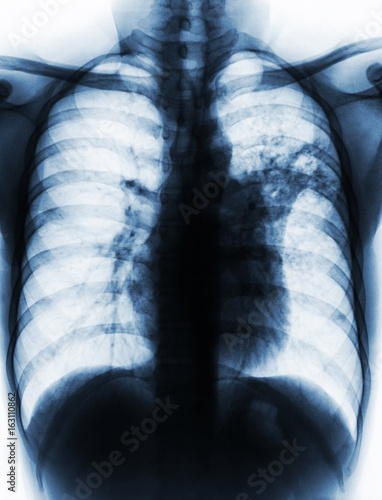 Pulmonary Tuberculosis . Film chest x-ray show alveolar infiltrate at left middle lung due to Mycobacterium tuberculosis infection . photo