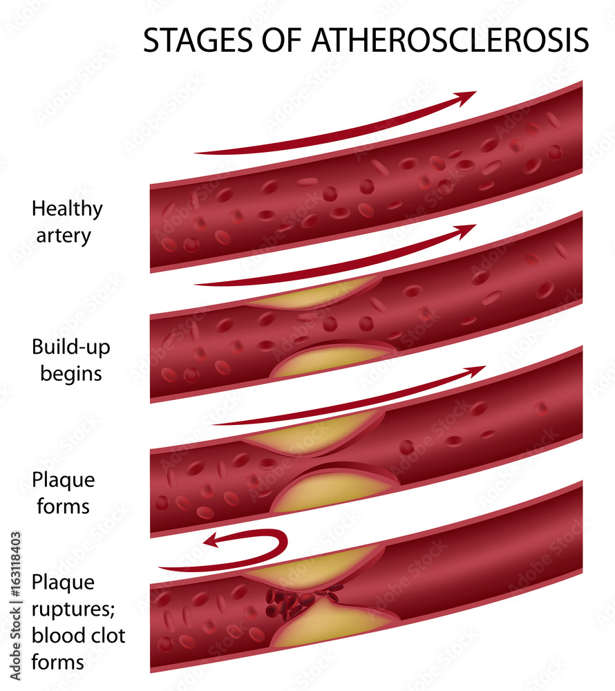 Stages of atherosclerosis Stock Illustration | Adobe Stock