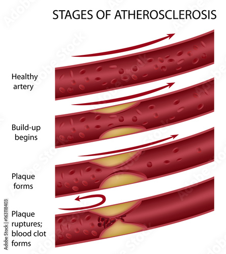 Stages of atherosclerosis photo