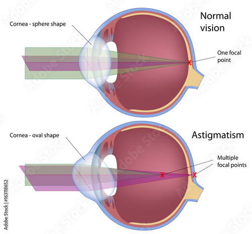 Astigmatism, a common eye defect photo
