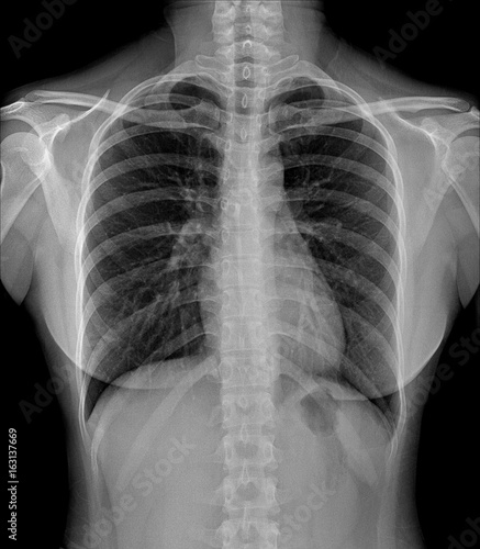 Fotografie digital image real human chest x-ray computer