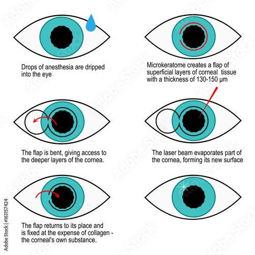 Procedure of laser correction of vision step by step. Infographics