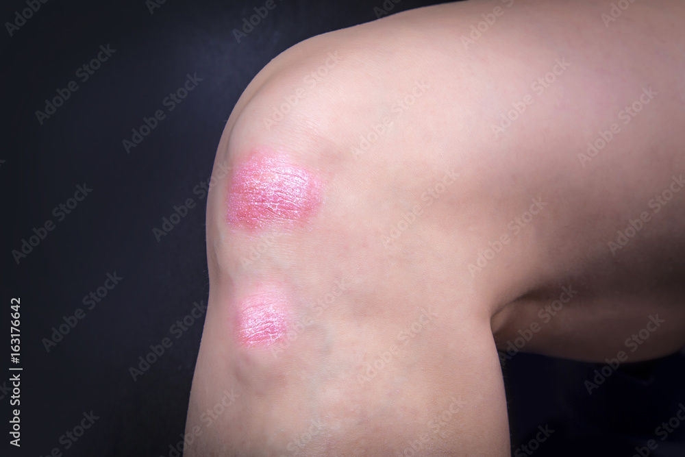 Fototapeta premium Psoriasis on ladys knee