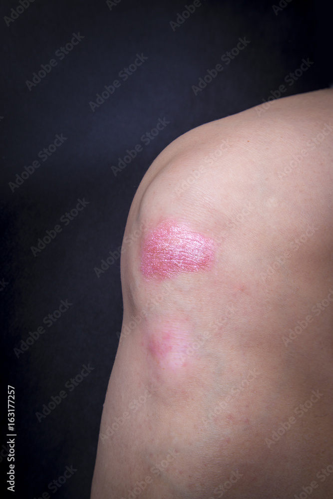 Fototapeta premium Psoriasis on ladys knee