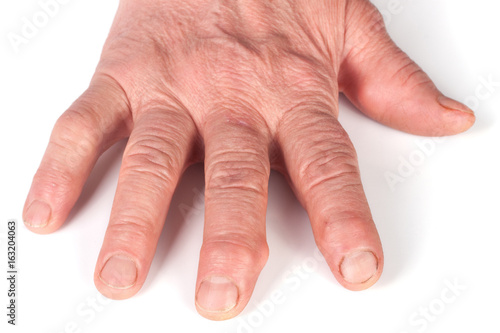 Rheumatoid polyarthritis of hands isolated on white background