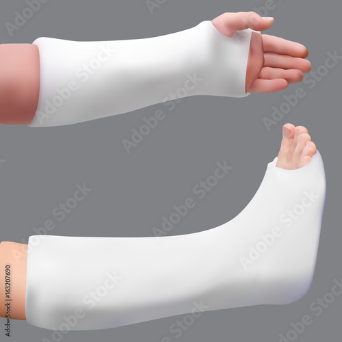 Plastered leg and arm. Treatment of a broken leg and broken arm. Medicine and health. Isolated realistic object. Vector