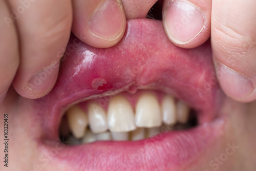 Close-up of stomatitis into mouth. Man bends his upper lip and shows stomatitis photo