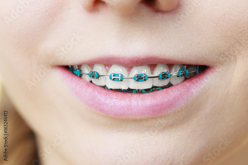 Closeup of woman teeth with braces