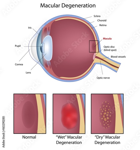Eye condition: macular degeneration photo