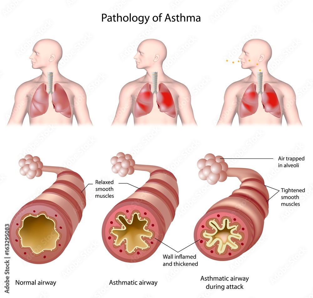 Anatomy Of Asthma Labeled Stock Illustration Adobe Stock