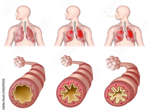 Fotografie Anatomy of asthma, unlabeled.