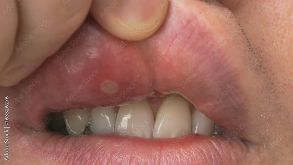 Stomatitis into mouth. Man bends his upper lip and shows sore spot of ulcer. Close-up Stomatitis into mouth. Man bends his upper lip and shows sore spot of ulcer. Close-up