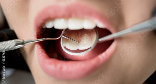 Macro shot of young woman having dental check up in dental clinic. Dentist examining a patient's teeth with dental tools - mirror and probe. Dentistry