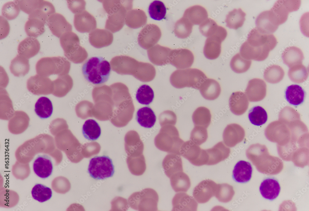 CLL blood smear CLL blood smear