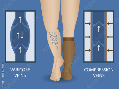 Medical compression socks for the treatment of varicose veins. photo