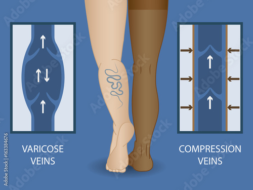 Medical compression stockings for the treatment of varicose veins. Medical hosiery.