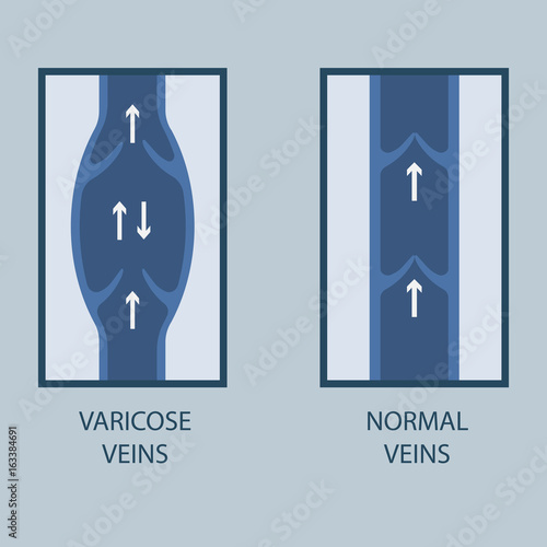 Vector illustration of a varicose vein and normal vein. Flat style.