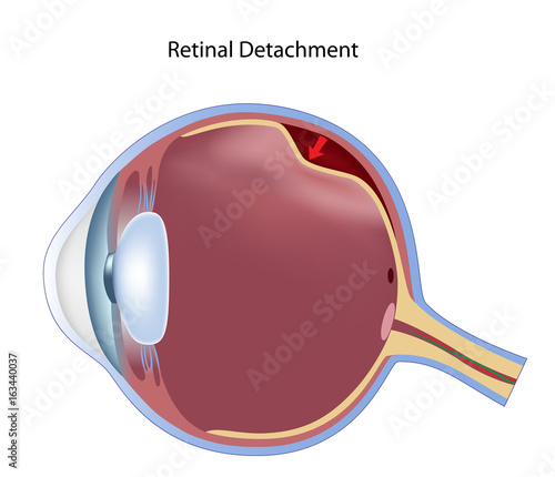 Retinal detachment, non-labeled