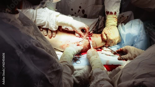  Operation. Operation of varicose veins. Surgery.