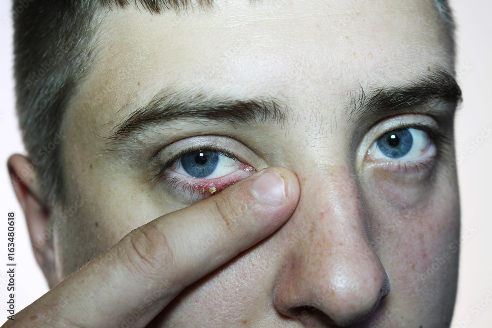 Fototapeta premium Close-up of an eye of a man. Ophthalmologic disease hordeolum eye. Doctor ophthalmologist examines purulent inflammation of the eyelid. Eyes and eyelid close-up