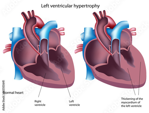 Heart disease - left ventricular hypertrophy, labeled. 