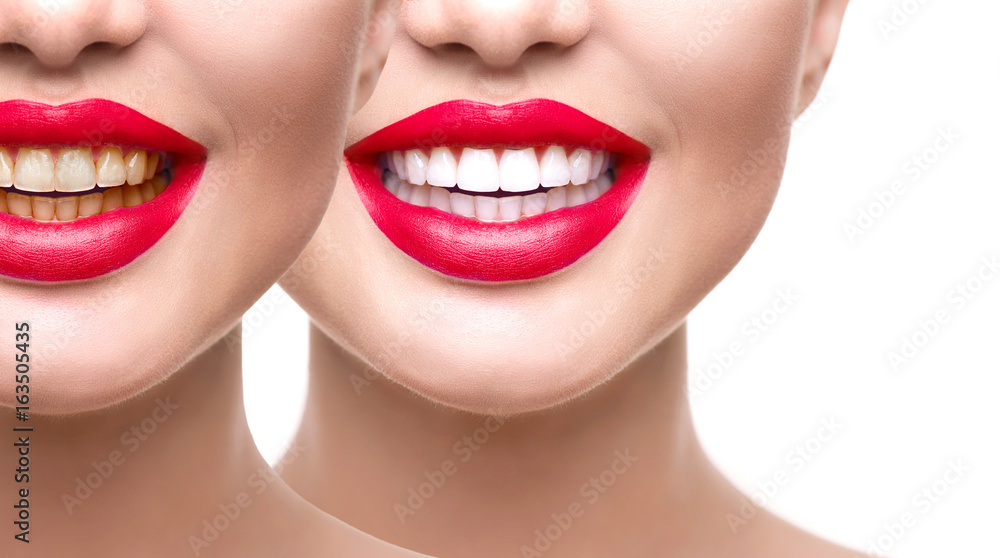 Obraz premium Woman teeth after whitening. Dental health concept