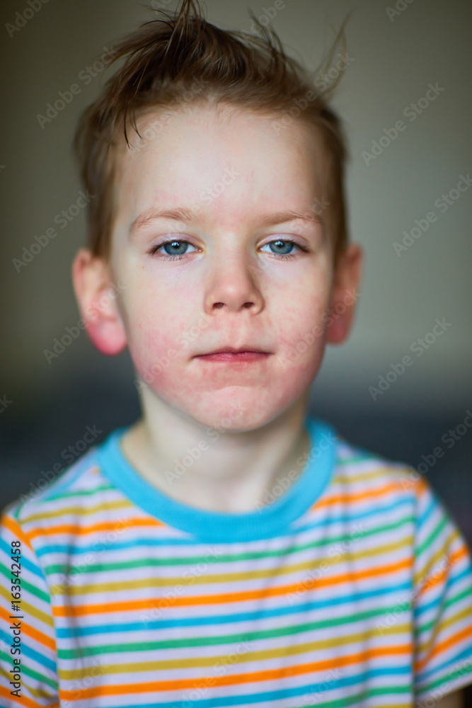 Allergic rash on the face of a boy Allergic rash on the face of a boy